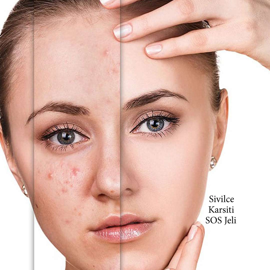 ژل ضد جوش sos نوتروژینا